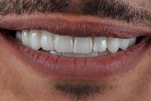 After results of Emax crowns