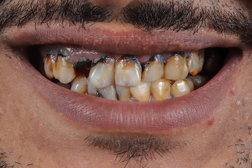 before Emax crowns