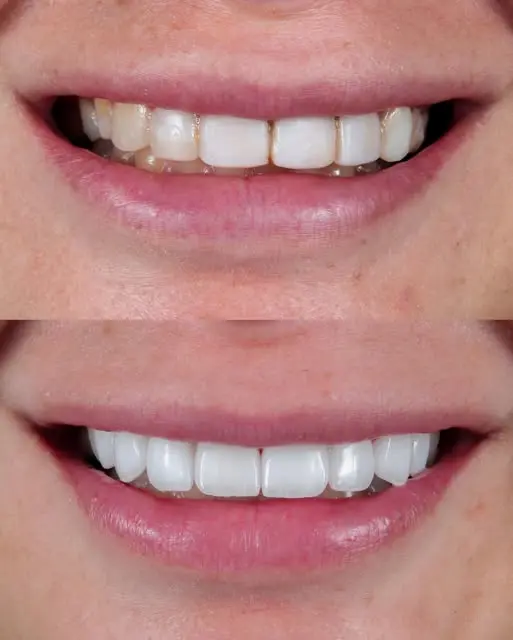 before and after photo for emax veneers