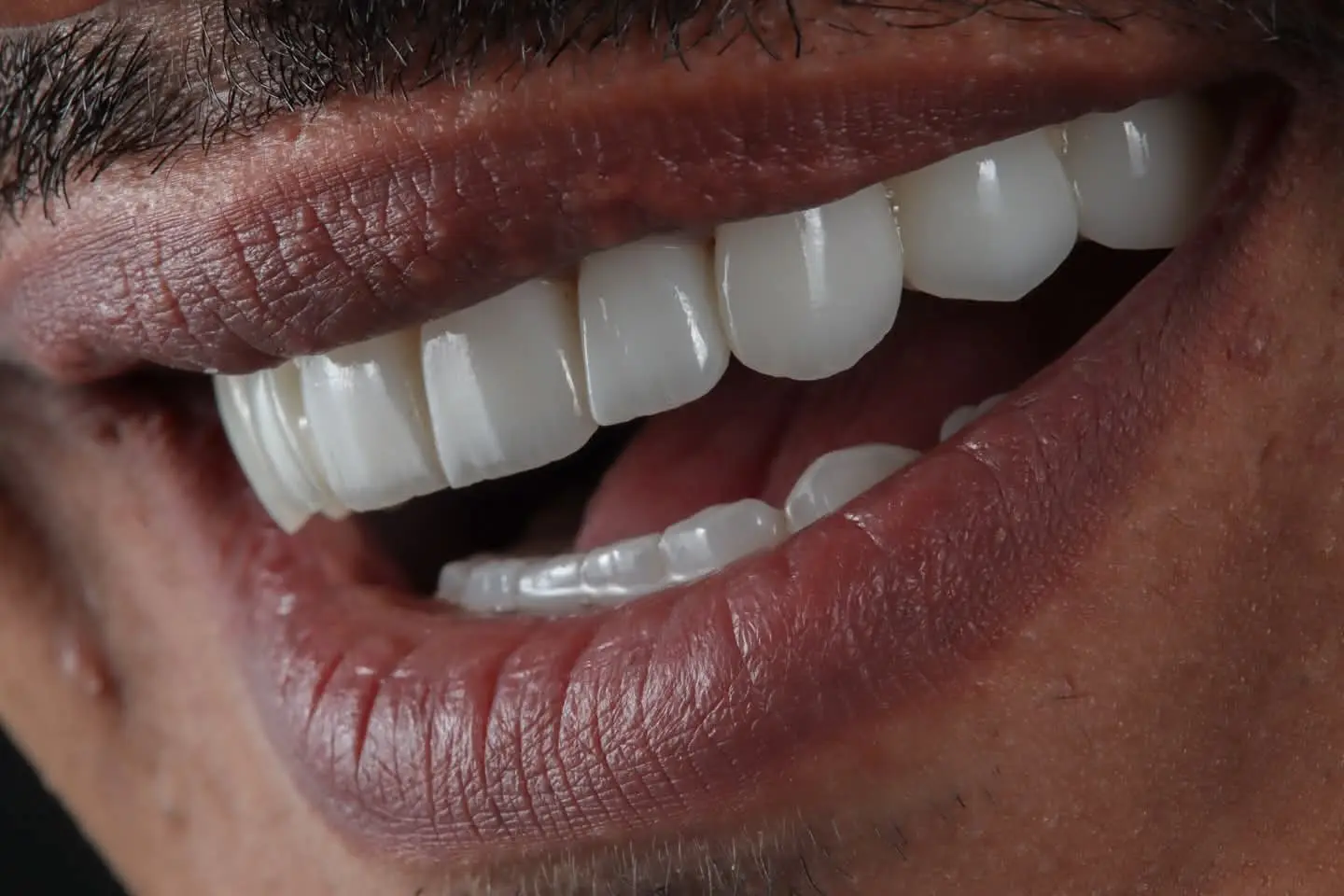 an after image of emax crowns