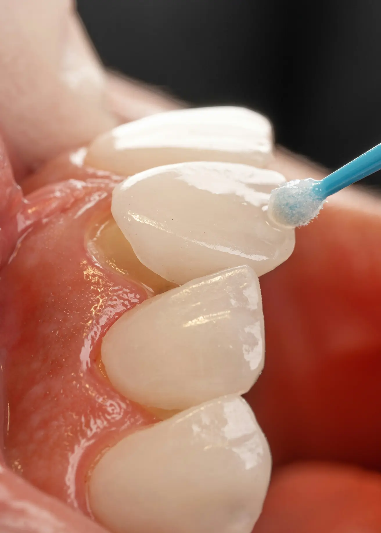 an image of veneers on teeth up close